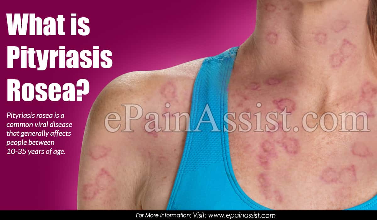 Herald Patch Pityriasis Rosea Causes Watchlasopa